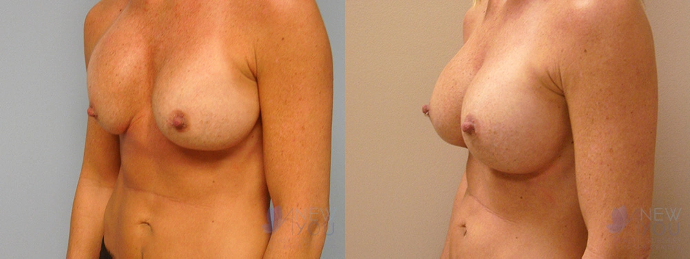 Real Patient Results by Dr. Shah of A New You Plastic Surgery & Medical Spa in Chicago, IL