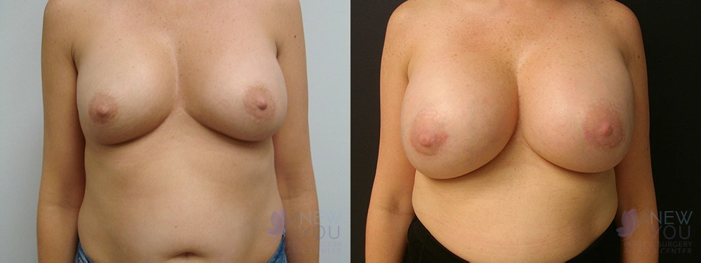 Real Patient Results by Dr. Shah of A New You Plastic Surgery & Medical Spa in Chicago, IL