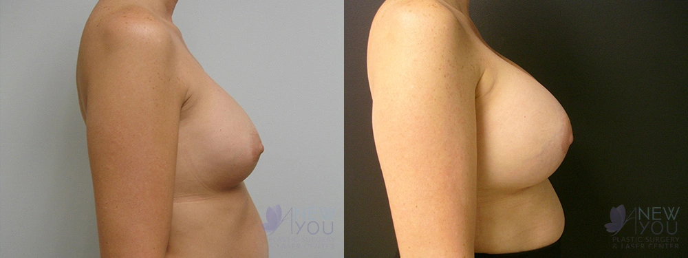 Real Patient Results by Dr. Shah of A New You Plastic Surgery & Medical Spa in Chicago, IL