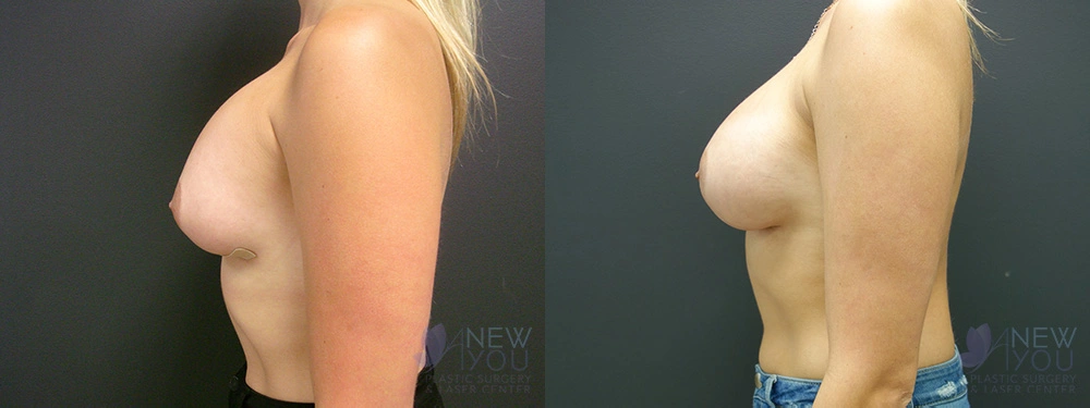 Real Patient Results by Dr. Shah of A New You Plastic Surgery & Medical Spa in Chicago, IL