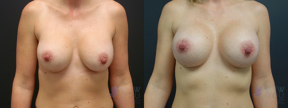 Real Patient Results by Dr. Shah of A New You Plastic Surgery & Medical Spa in Chicago, IL