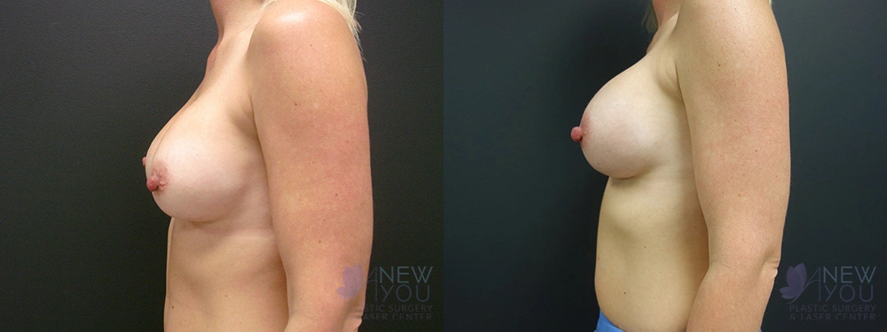 Real Patient Results by Dr. Shah of A New You Plastic Surgery & Medical Spa in Chicago, IL