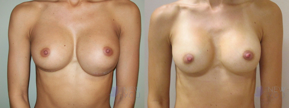 Real Patient Results by Dr. Shah of A New You Plastic Surgery & Medical Spa in Chicago, IL