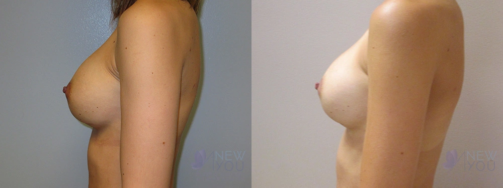 Real Patient Results by Dr. Shah of A New You Plastic Surgery & Medical Spa in Chicago, IL