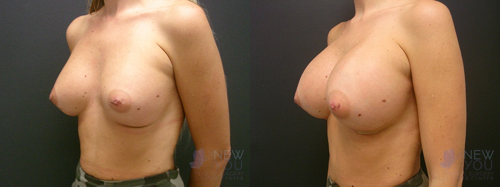 Real Patient Results by Dr. Shah of A New You Plastic Surgery & Medical Spa in Chicago, IL