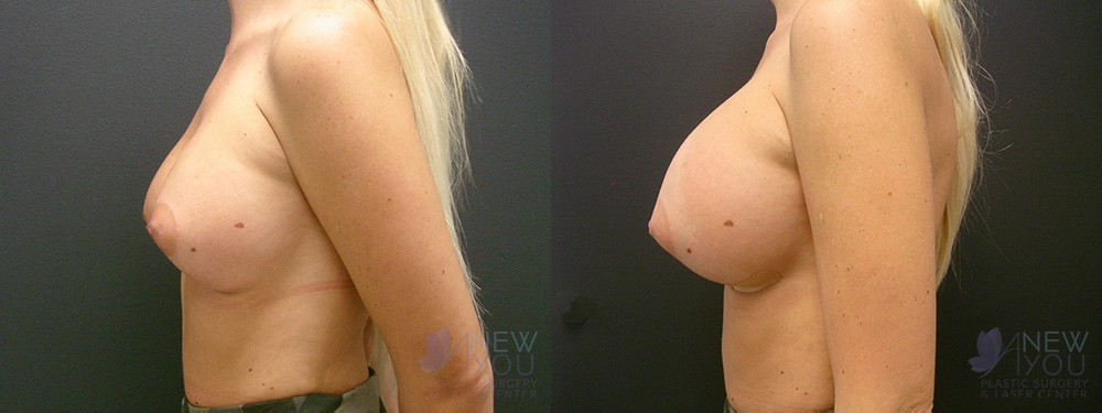 Real Patient Results by Dr. Shah of A New You Plastic Surgery & Medical Spa in Chicago, IL