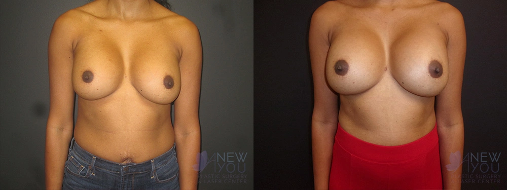 Real Patient Results by Dr. Shah of A New You Plastic Surgery & Medical Spa in Chicago, IL