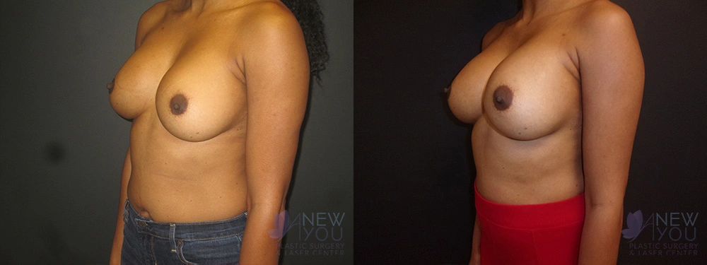 Real Patient Results by Dr. Shah of A New You Plastic Surgery & Medical Spa in Chicago, IL