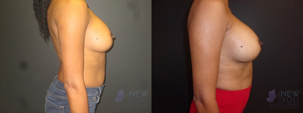 Real Patient Results by Dr. Shah of A New You Plastic Surgery & Medical Spa in Chicago, IL