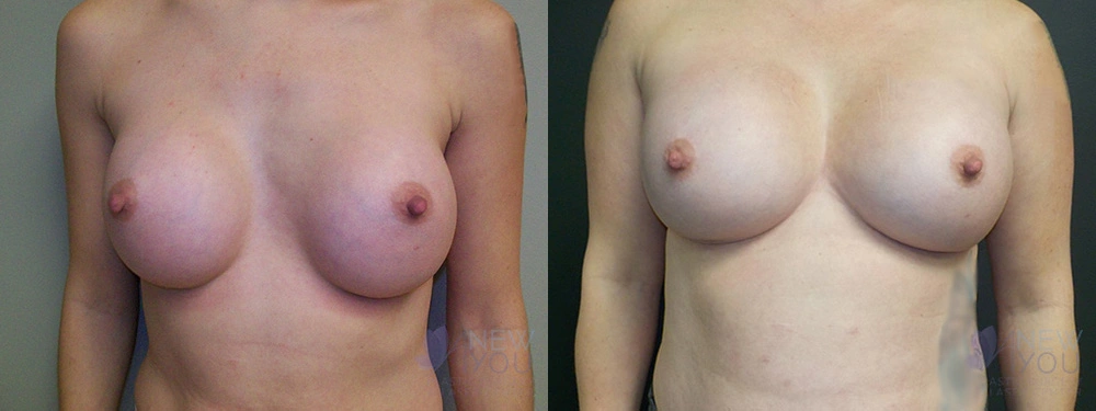Real Patient Results by Dr. Shah of A New You Plastic Surgery & Medical Spa in Chicago, IL