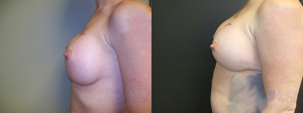 Real Patient Results by Dr. Shah of A New You Plastic Surgery & Medical Spa in Chicago, IL