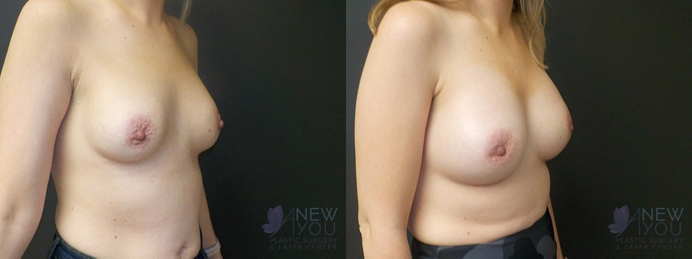 Real Patient Results by Dr. Shah of A New You Plastic Surgery & Medical Spa in Chicago, IL