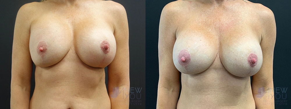 Real Patient Results by Dr. Shah of A New You Plastic Surgery & Medical Spa in Chicago, IL