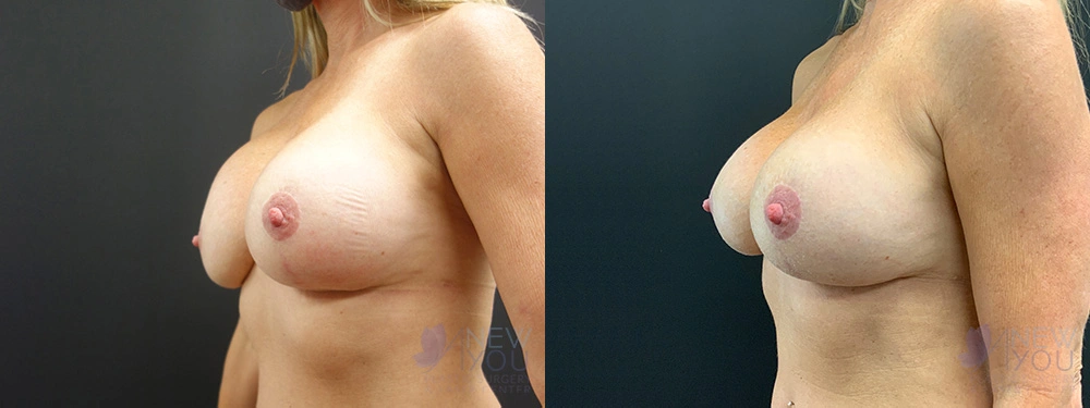 Real Patient Results by Dr. Shah of A New You Plastic Surgery & Medical Spa in Chicago, IL