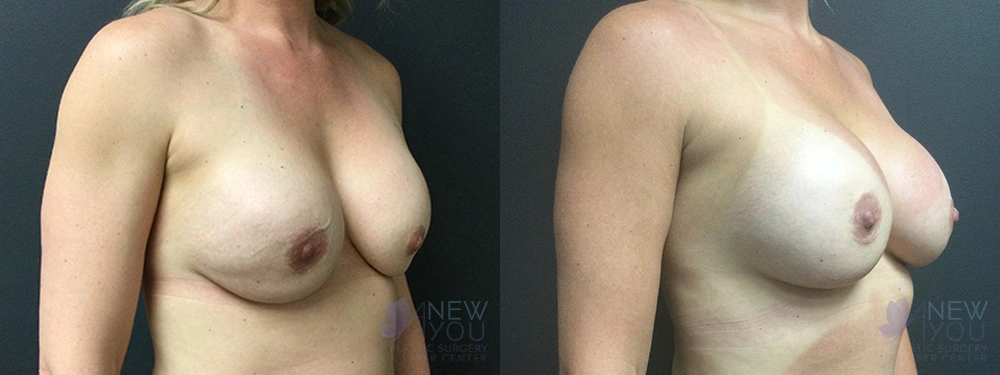 Real Patient Results by Dr. Shah of A New You Plastic Surgery & Medical Spa in Chicago, IL