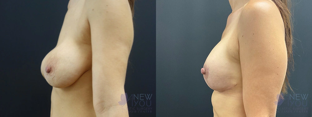 Real Patient Results by Dr. Shah of A New You Plastic Surgery & Medical Spa in Chicago, IL