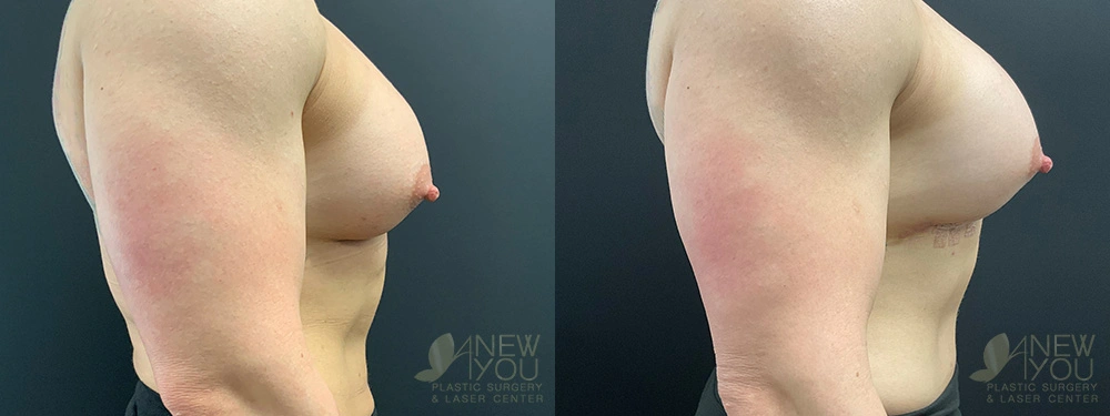 Real Patient Results by Dr. Shah of A New You Plastic Surgery & Medical Spa in Chicago, IL