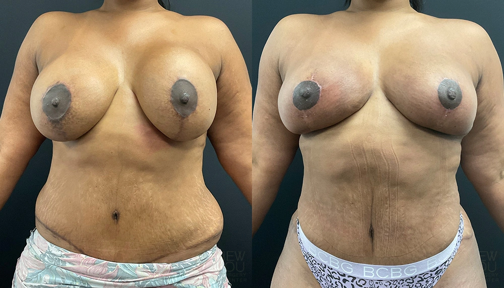 Real Patient Results by Dr. Shah of A New You Plastic Surgery & Medical Spa in Chicago, IL