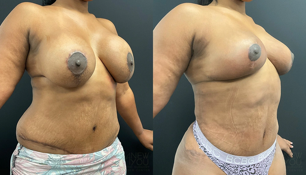 Real Patient Results by Dr. Shah of A New You Plastic Surgery & Medical Spa in Chicago, IL