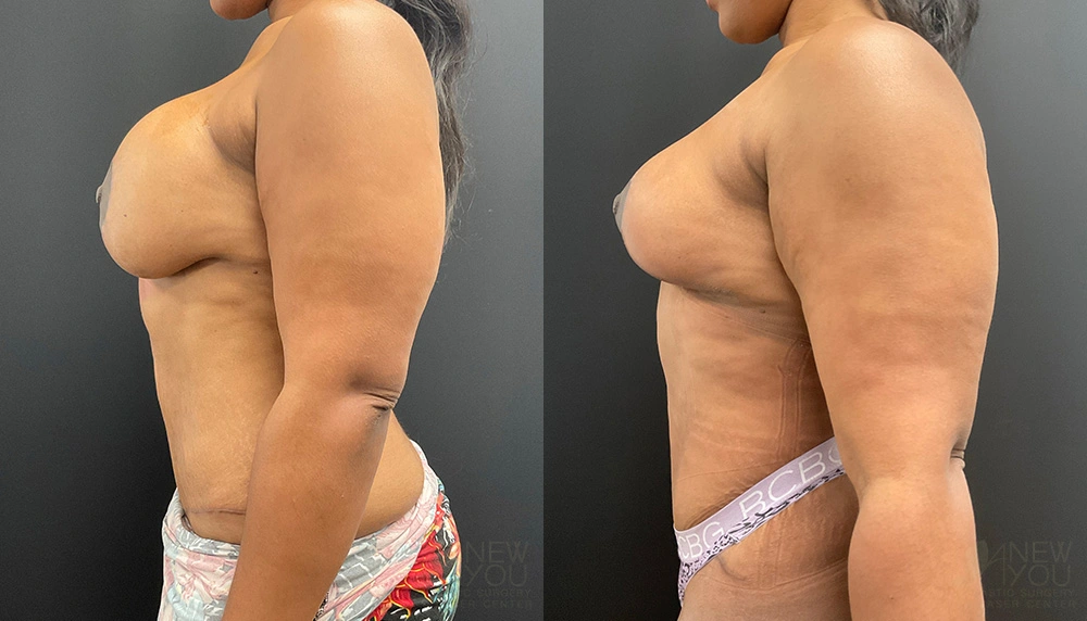 Real Patient Results by Dr. Shah of A New You Plastic Surgery & Medical Spa in Chicago, IL
