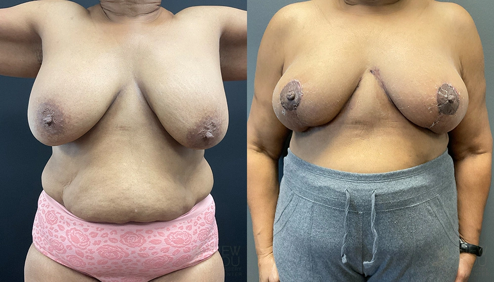 Real Patient Results by Dr. Shah of A New You Plastic Surgery & Medical Spa in Chicago, IL