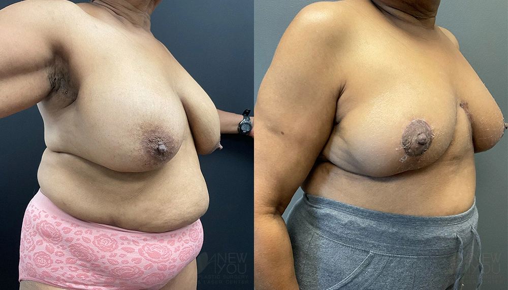 Real Patient Results by Dr. Shah of A New You Plastic Surgery & Medical Spa in Chicago, IL