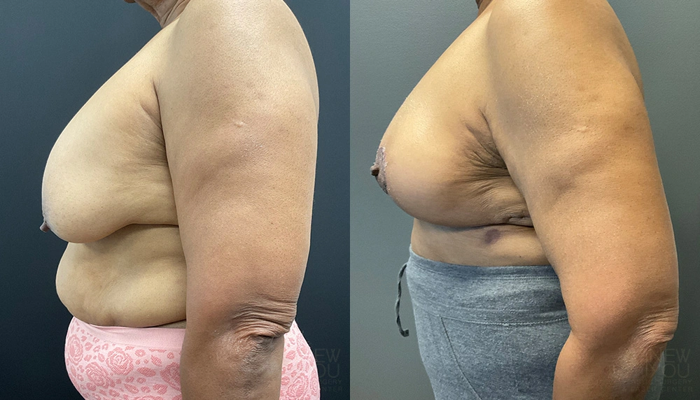 Real Patient Results by Dr. Shah of A New You Plastic Surgery & Medical Spa in Chicago, IL