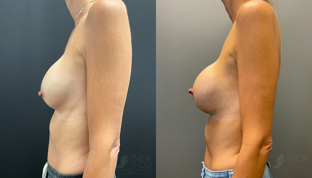 Real Patient Results by Dr. Shah of A New You Plastic Surgery & Medical Spa in Chicago, IL