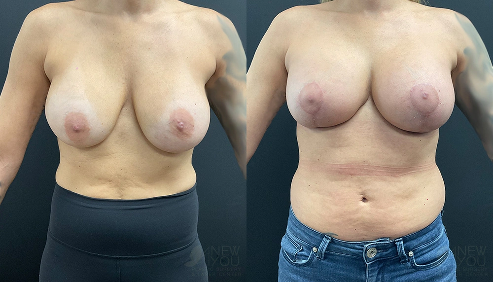 Real Patient Results by Dr. Shah of A New You Plastic Surgery & Medical Spa in Chicago, IL