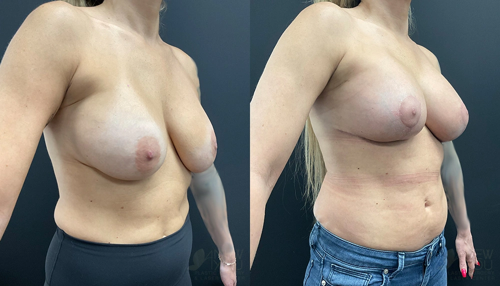 Real Patient Results by Dr. Shah of A New You Plastic Surgery & Medical Spa in Chicago, IL