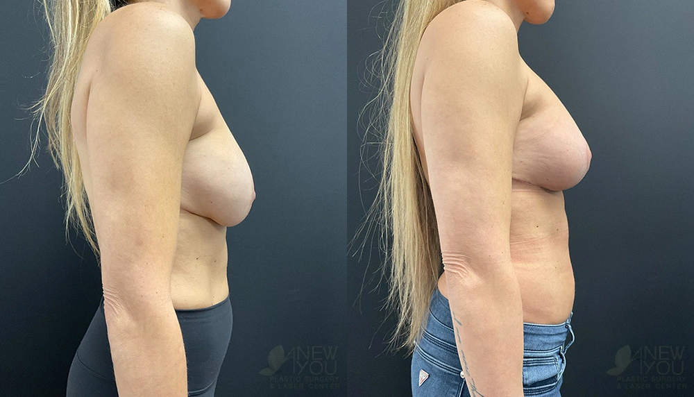 Real Patient Results by Dr. Shah of A New You Plastic Surgery & Medical Spa in Chicago, IL