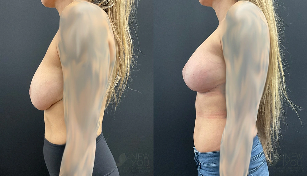 Real Patient Results by Dr. Shah of A New You Plastic Surgery & Medical Spa in Chicago, IL