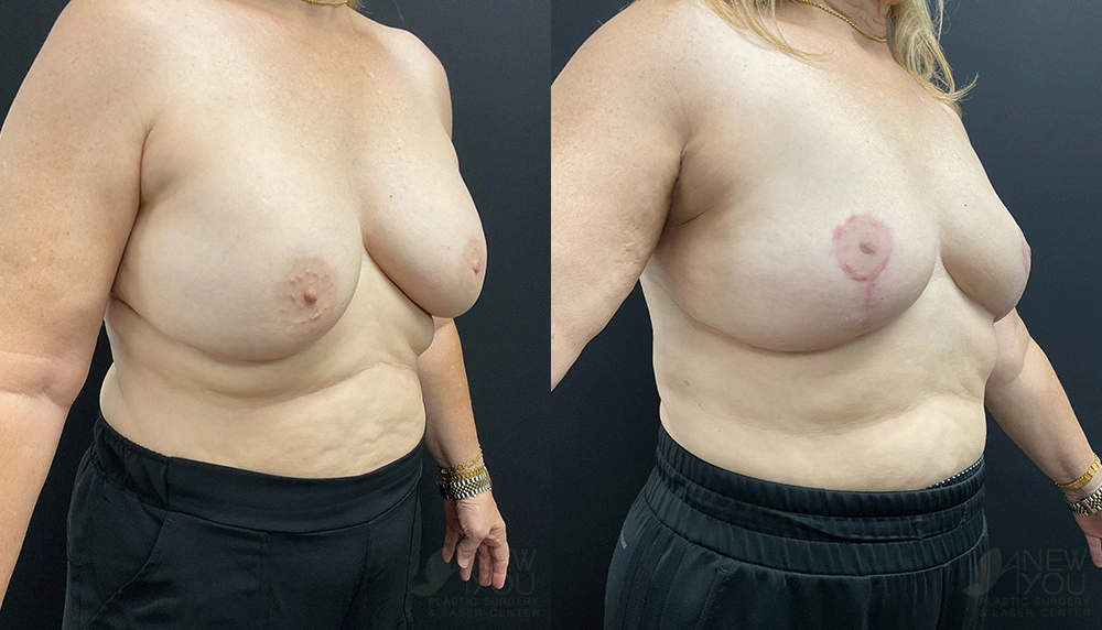 Real Patient Results by Dr. Shah of A New You Plastic Surgery & Medical Spa in Chicago, IL