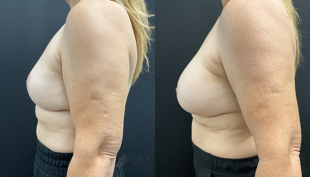 Real Patient Results by Dr. Shah of A New You Plastic Surgery & Medical Spa in Chicago, IL