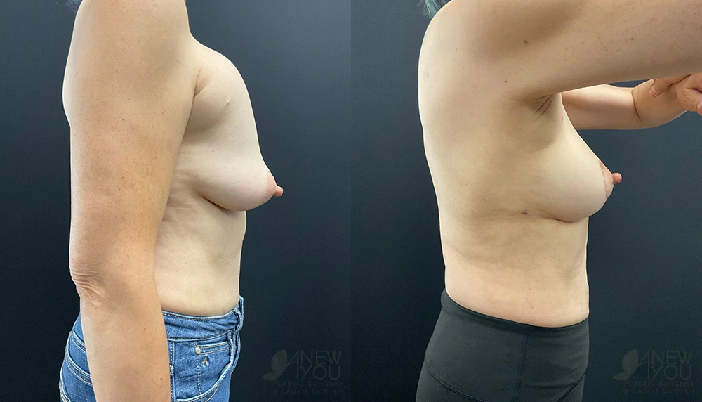 Real Patient Results by Dr. Shah of A New You Plastic Surgery & Medical Spa in Chicago, IL