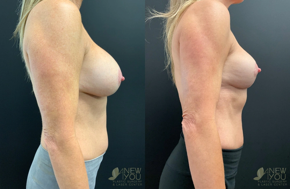 Real Patient Results by Dr. Shah of A New You Plastic Surgery & Medical Spa in Chicago, IL