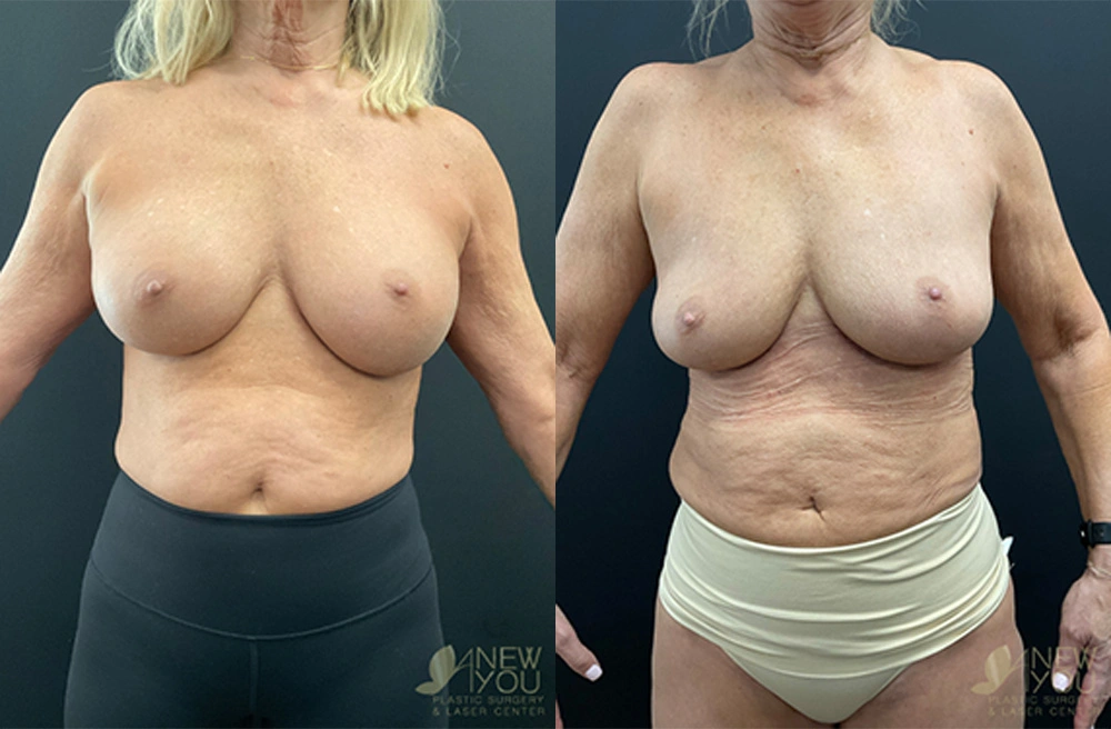 breast-revision-23a-post