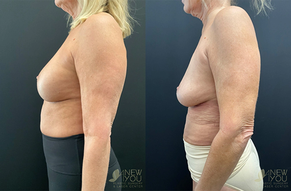 breast-revision-23b-post