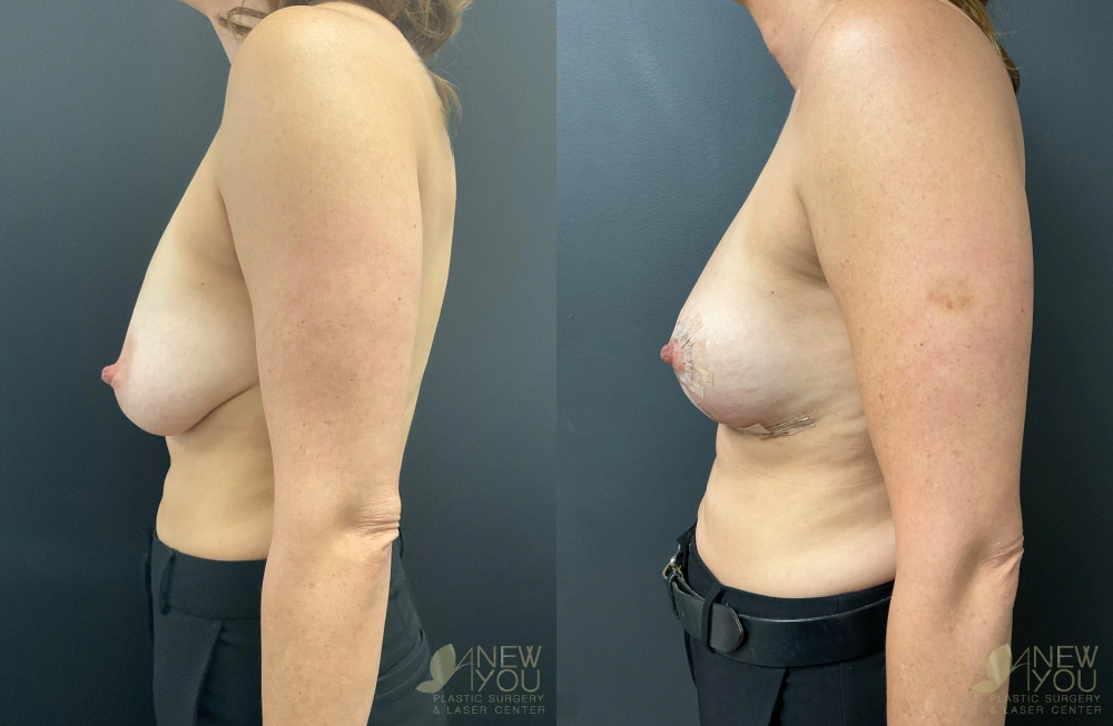 Real Patient Results by Dr. Shah of A New You Plastic Surgery & Medical Spa in Chicago, IL