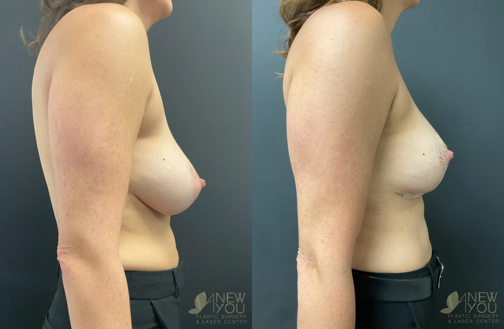 Real Patient Results by Dr. Shah of A New You Plastic Surgery & Medical Spa in Chicago, IL