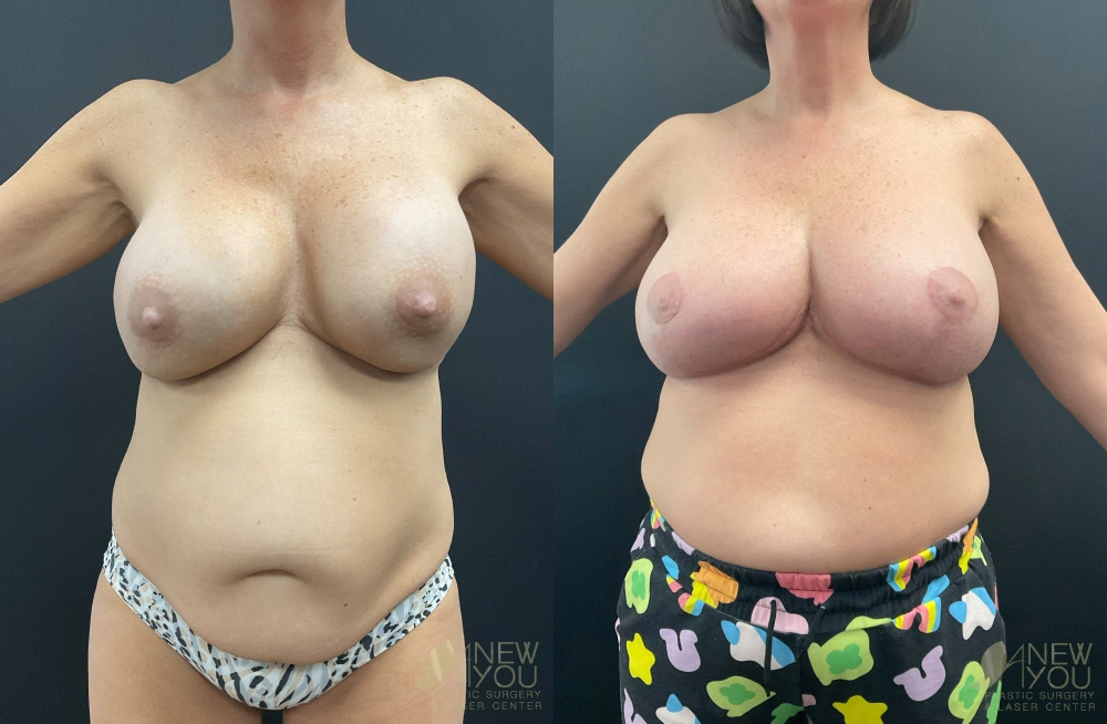 Real Patient Results by Dr. Shah of A New You Plastic Surgery & Medical Spa in Chicago, IL