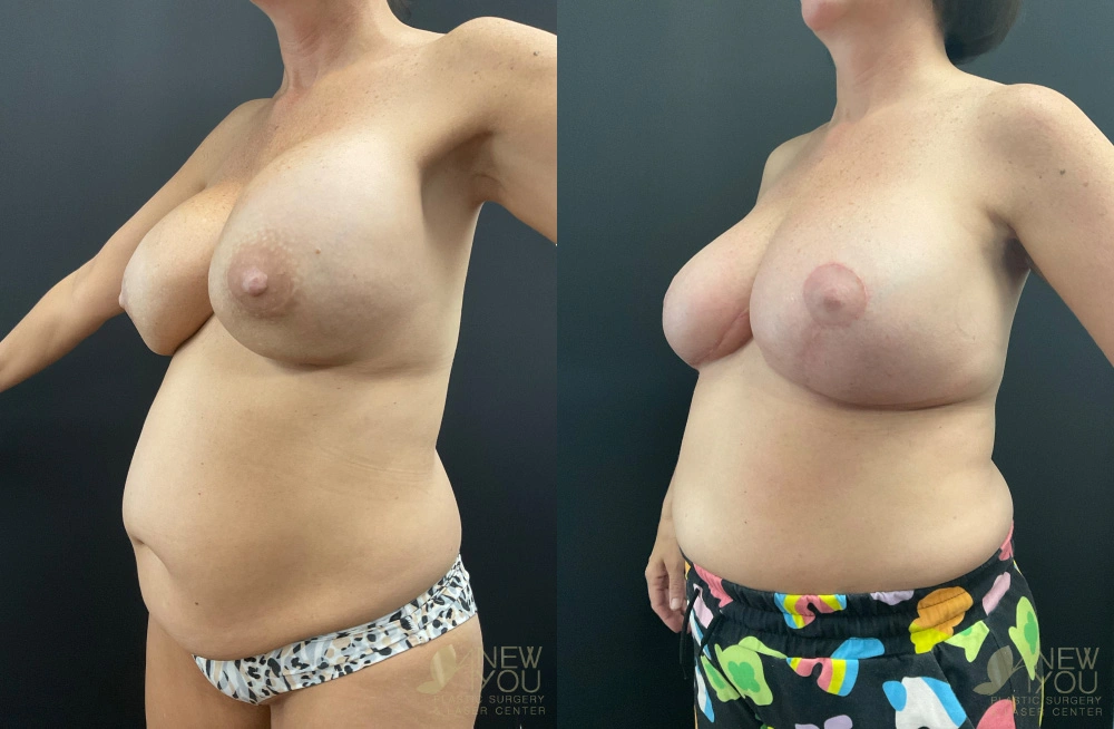 Real Patient Results by Dr. Shah of A New You Plastic Surgery & Medical Spa in Chicago, IL