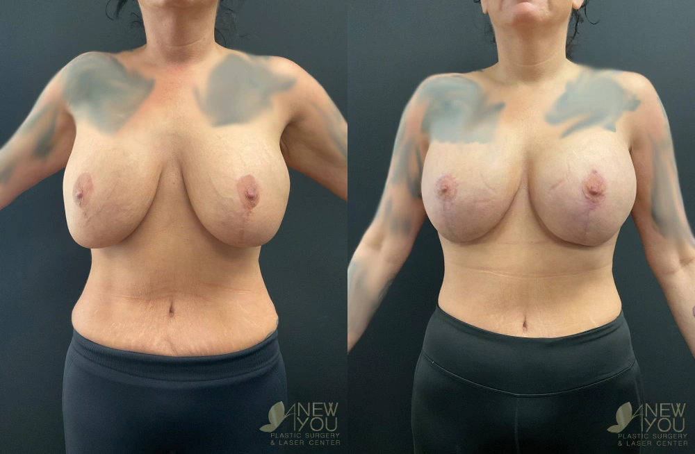 Real Patient Results by Dr. Shah of A New You Plastic Surgery & Medical Spa in Chicago, IL