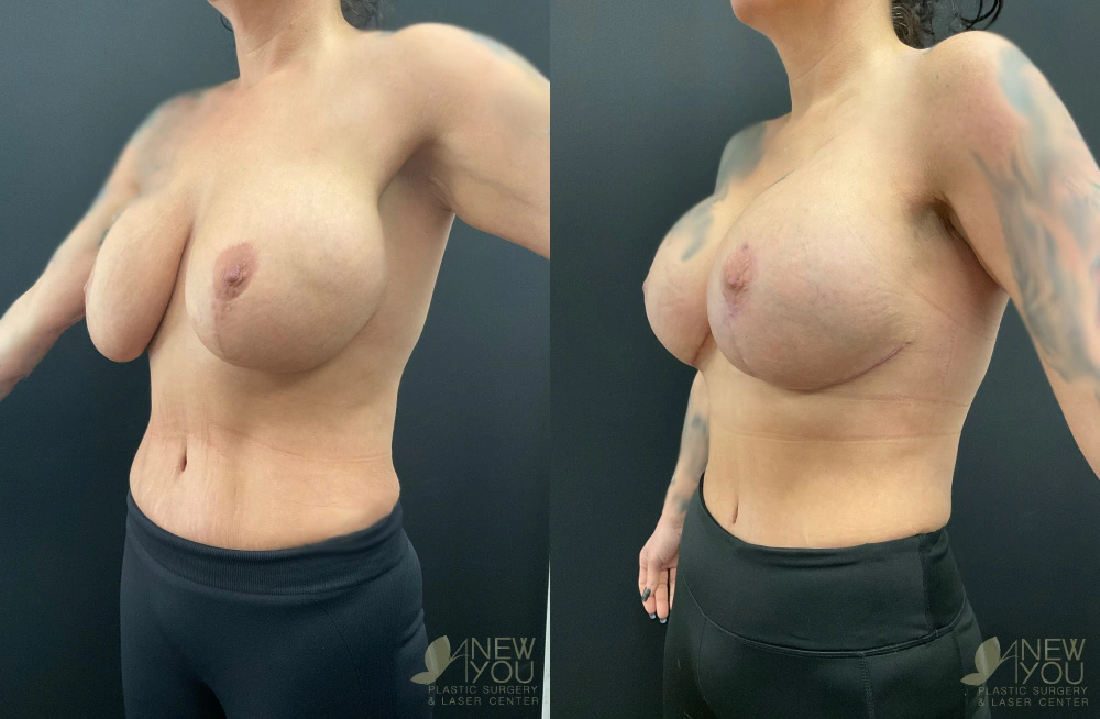 Real Patient Results by Dr. Shah of A New You Plastic Surgery & Medical Spa in Chicago, IL