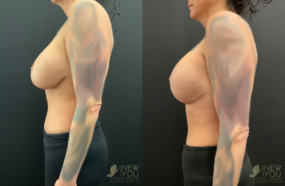 Real Patient Results by Dr. Shah of A New You Plastic Surgery & Medical Spa in Chicago, IL