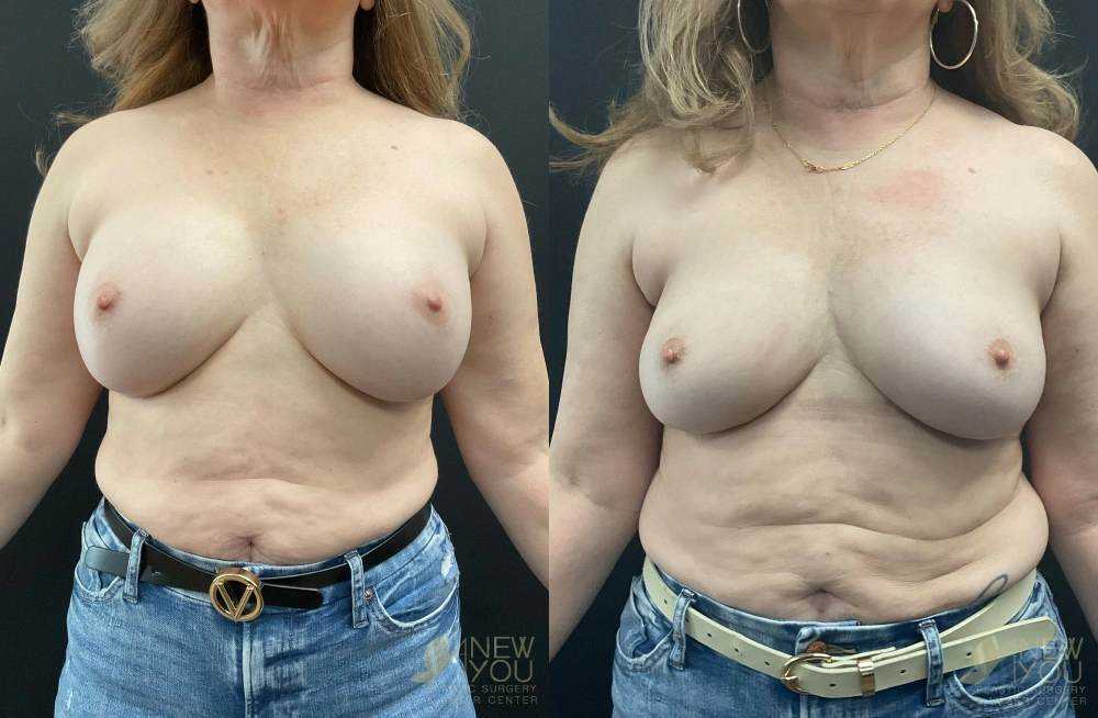 Real Patient Results by Dr. Shah of A New You Plastic Surgery & Medical Spa in Chicago, IL