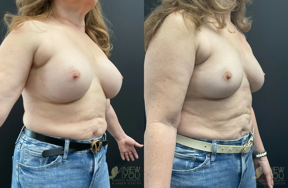 Real Patient Results by Dr. Shah of A New You Plastic Surgery & Medical Spa in Chicago, IL