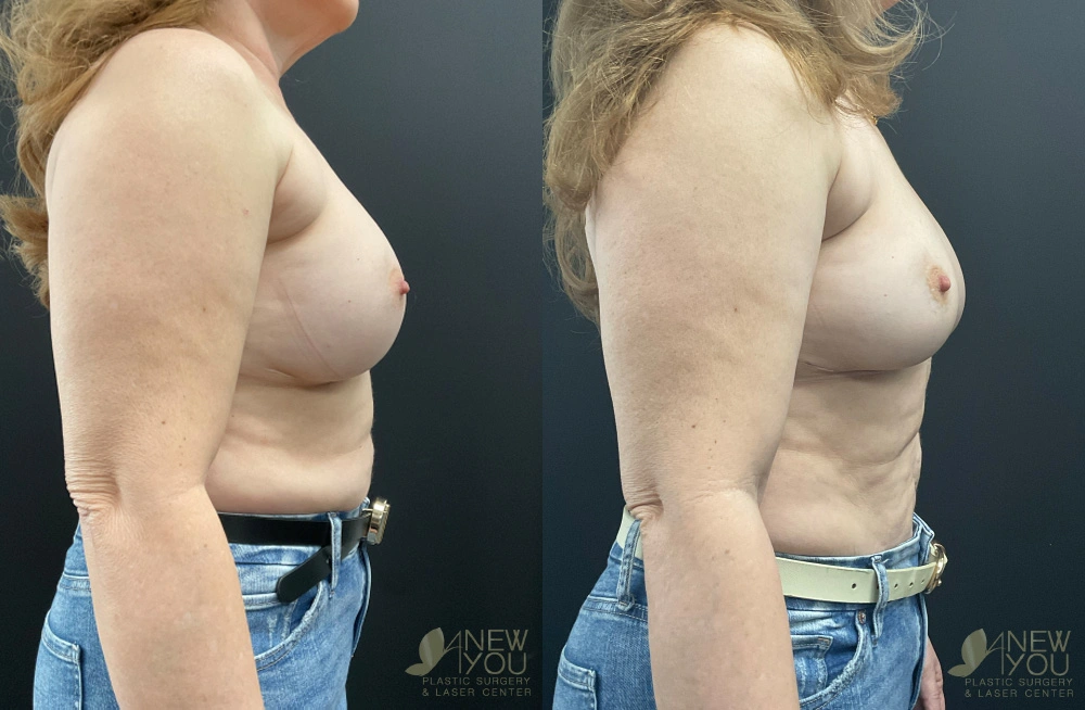 Real Patient Results by Dr. Shah of A New You Plastic Surgery & Medical Spa in Chicago, IL