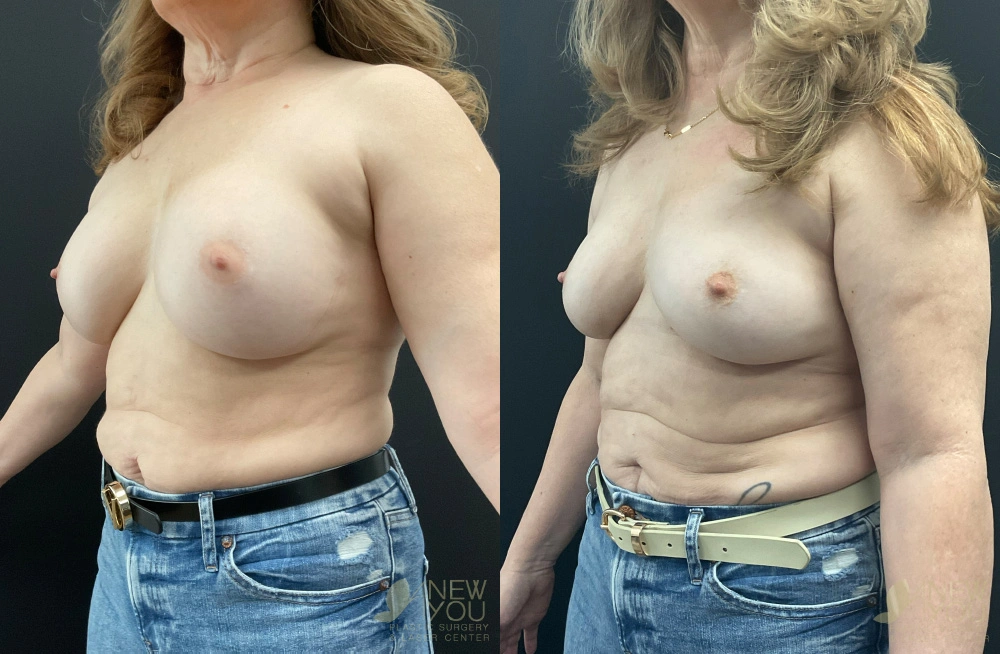 Real Patient Results by Dr. Shah of A New You Plastic Surgery & Medical Spa in Chicago, IL