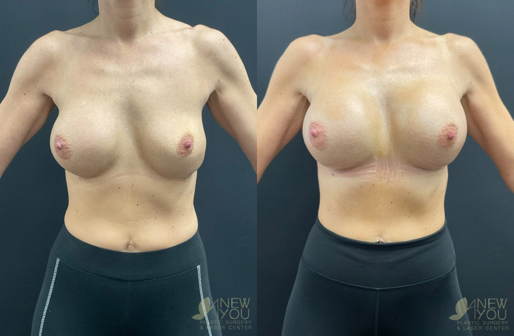 Real Patient Results by Dr. Shah of A New You Plastic Surgery & Medical Spa in Chicago, IL